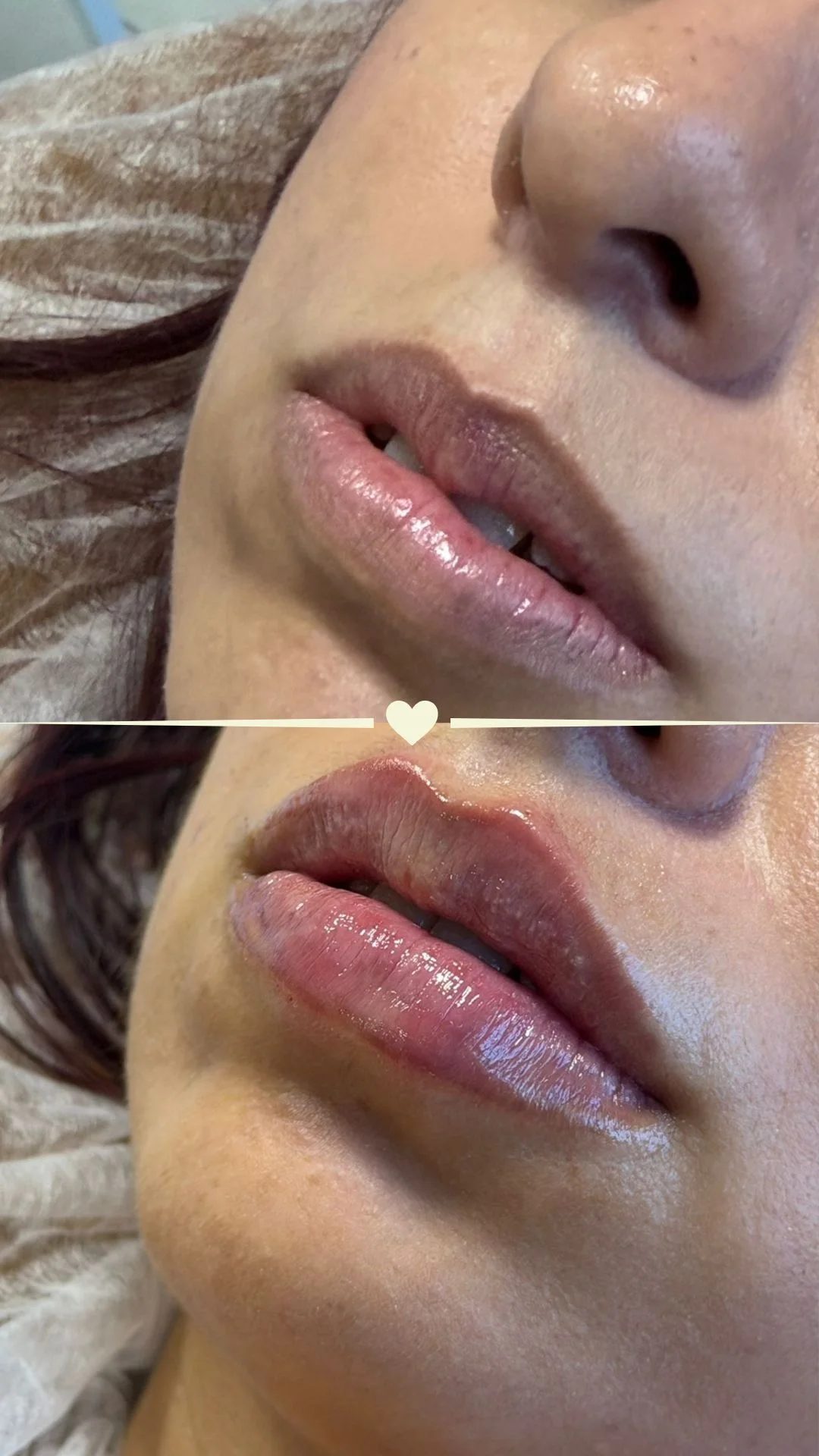 Resultado de preenchimento labial natural