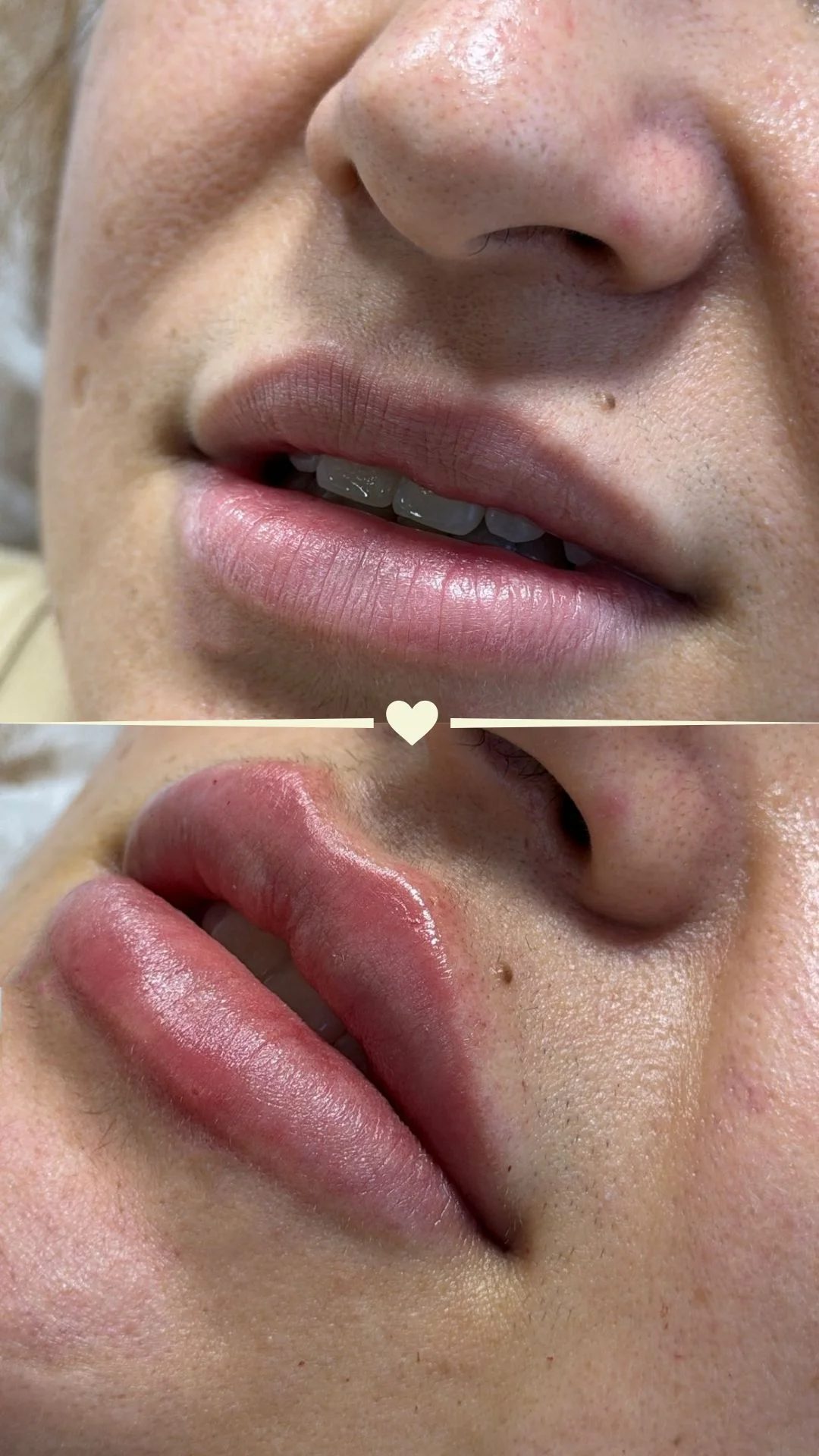 Resultado de preenchimento labial personalizado