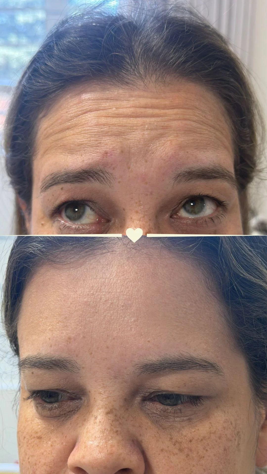 Resultado de toxina botulínica no terço superior