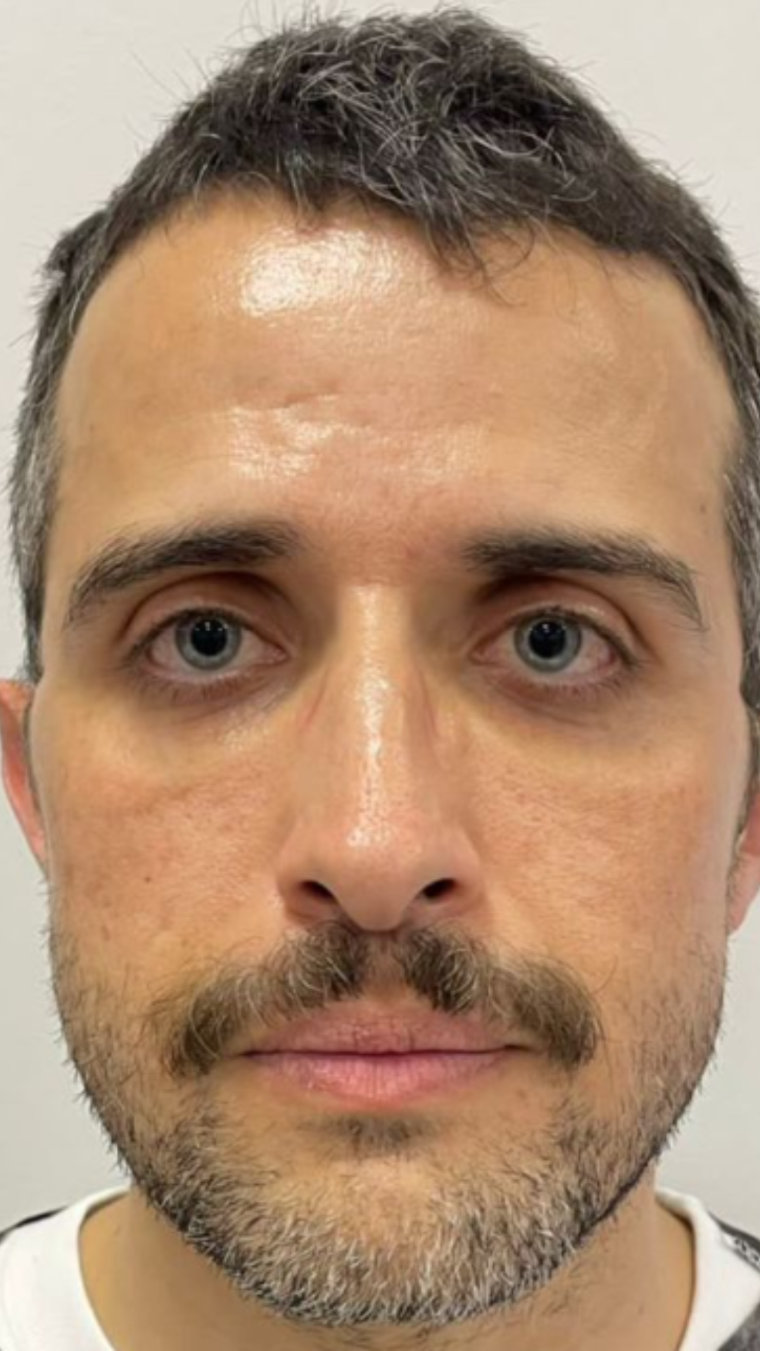 Antes do protocolo regenerativo facial