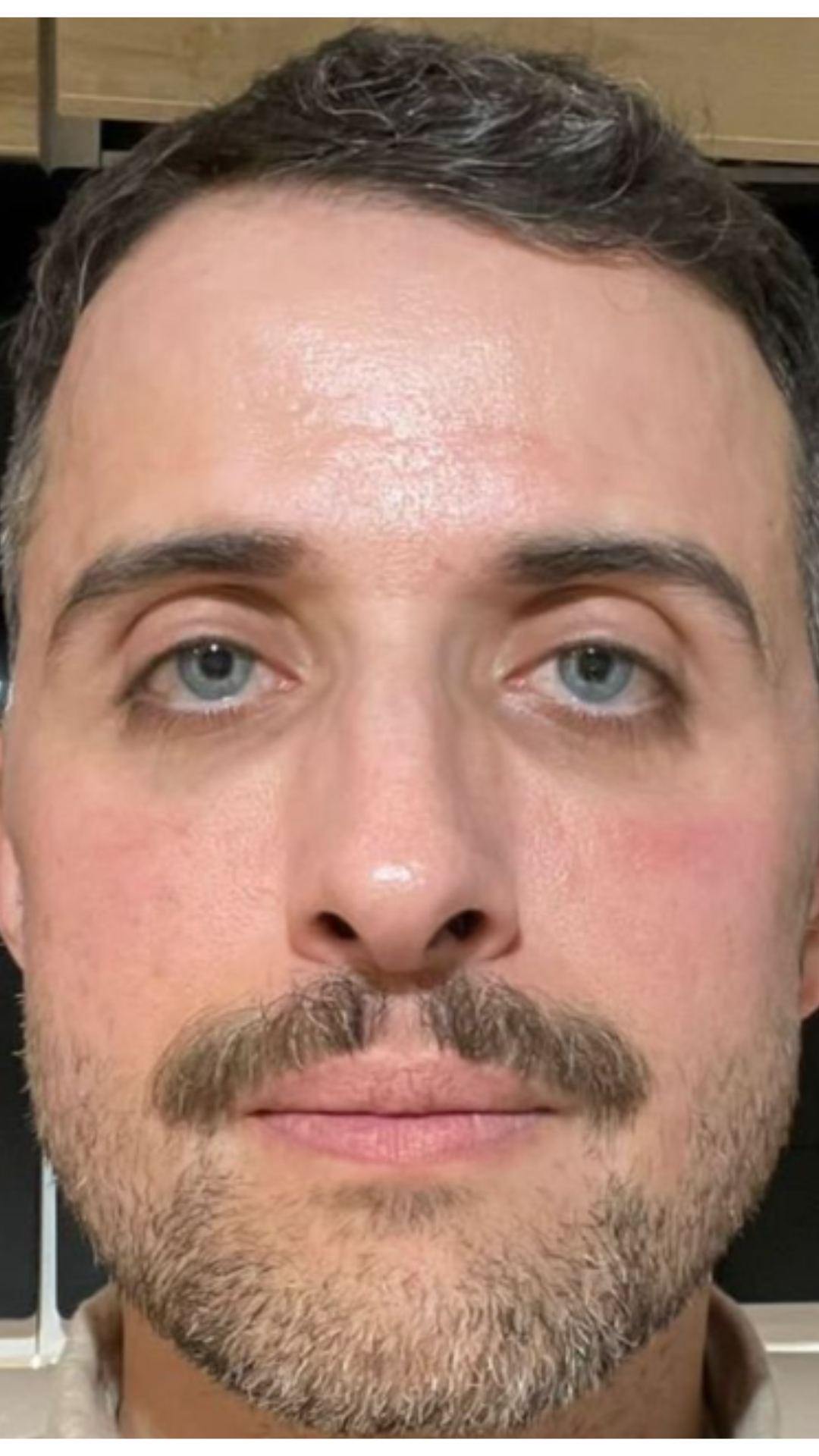 Depois do protocolo regenerativo facial